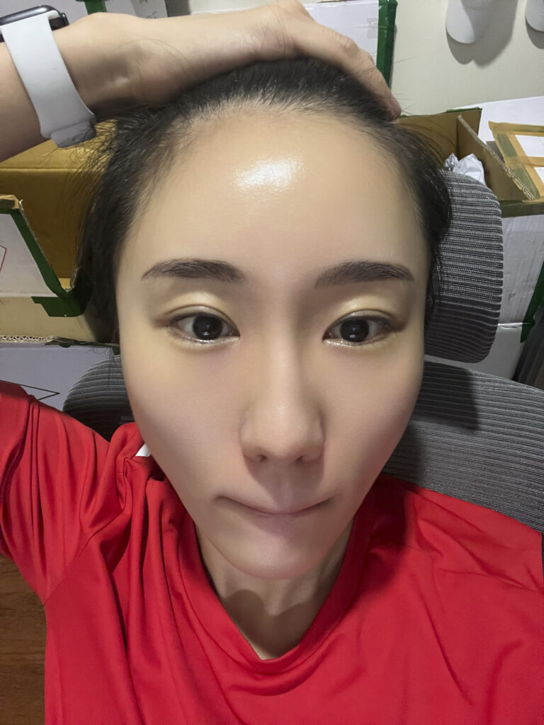 Face before Dermall Matrix sheet mask application, one of many nights over five years